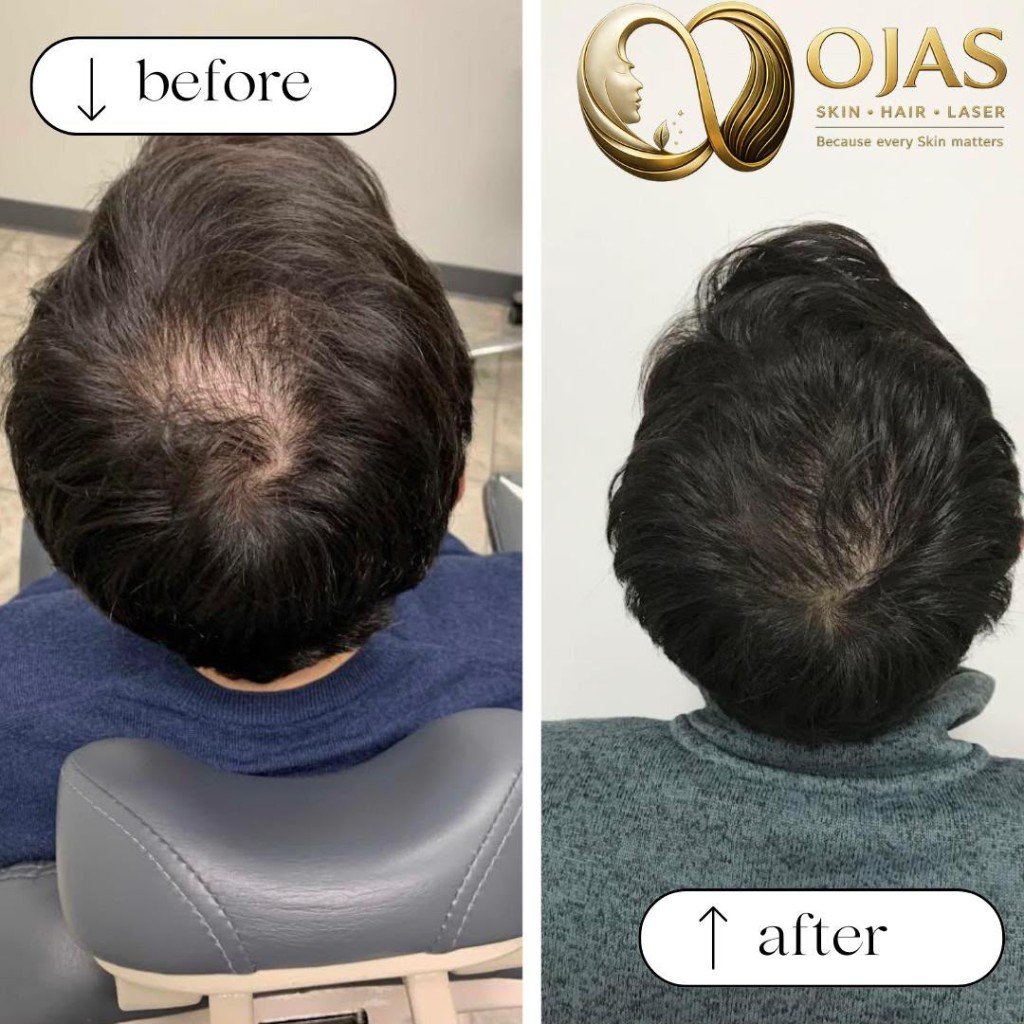 Hair restoration